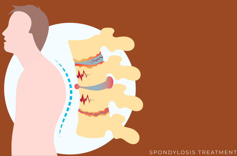 best doctor for spondylosis treatment in Vashi